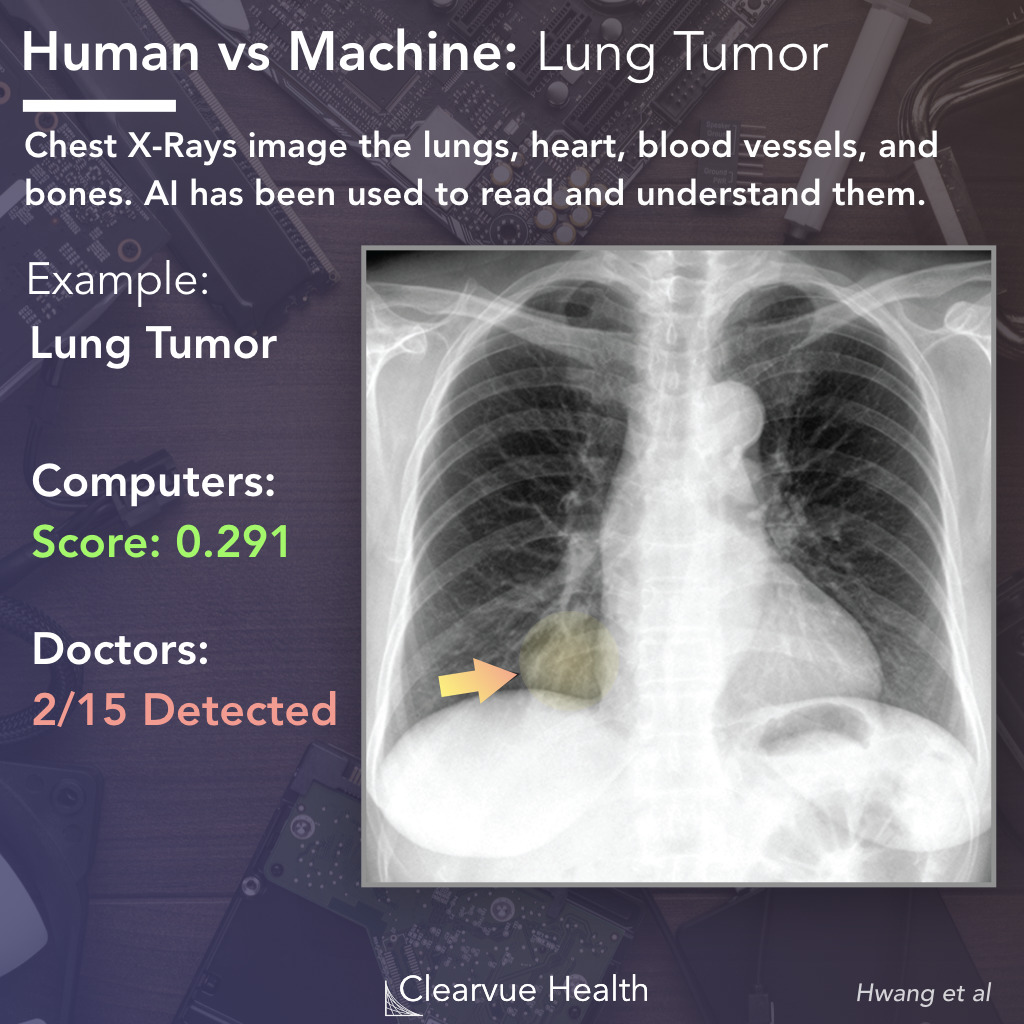 AI vs Doctor: Lung Tumor Recognition on a Chest X-ray