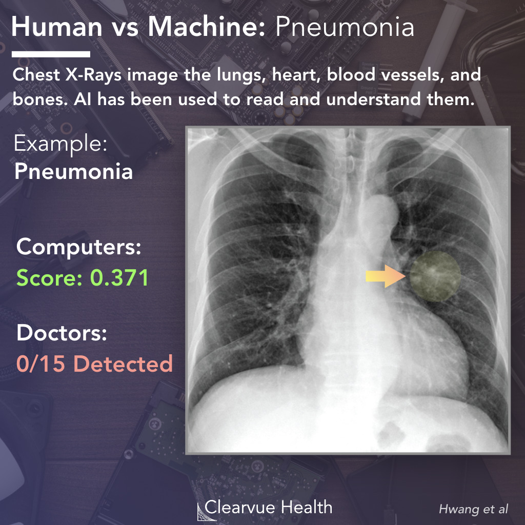 AI vs Doctor: Pneumonia Recognition on a Chest X-ray